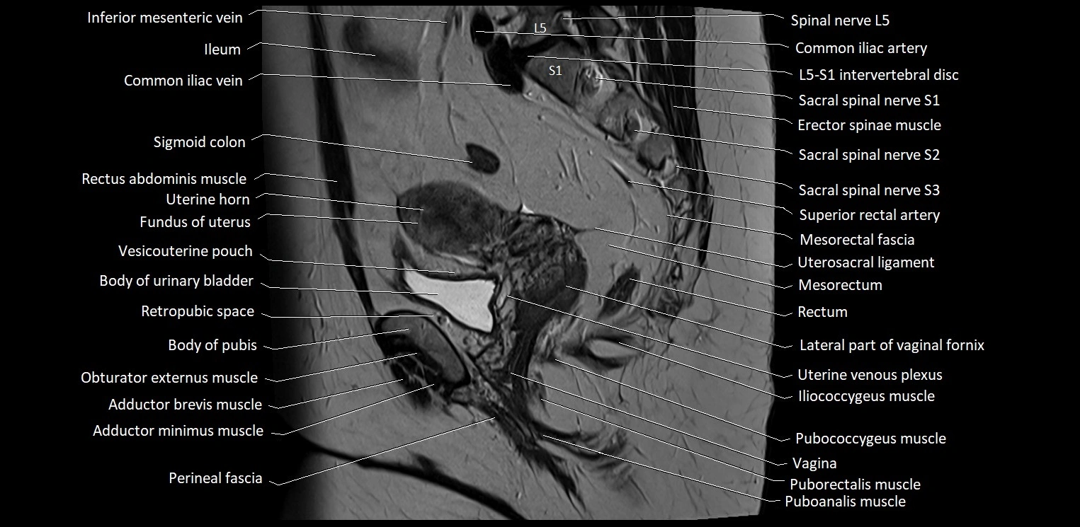 Sagittal cross sectional anatomy of female pelvis (MRI 3T) image 26.webp